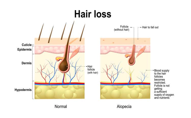 Hair-Loss-Treatment