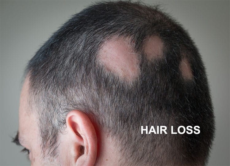 Hair-Loss