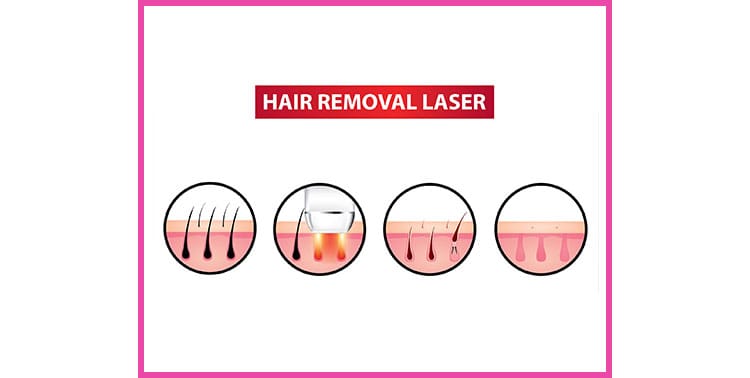 Hair Removal Laser