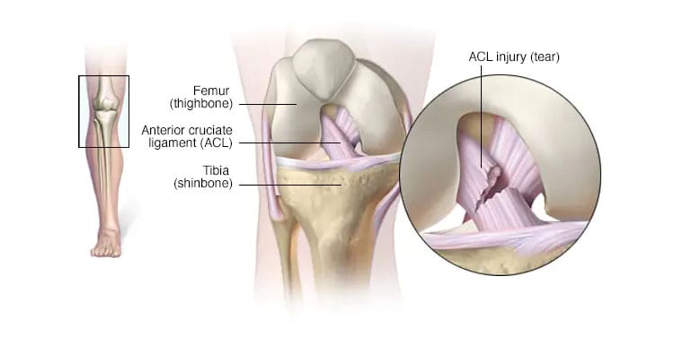 Knee pain - Symptoms and causes