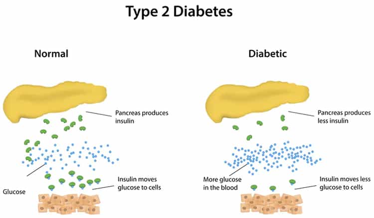 How To Manage Type 2 Diabetes
