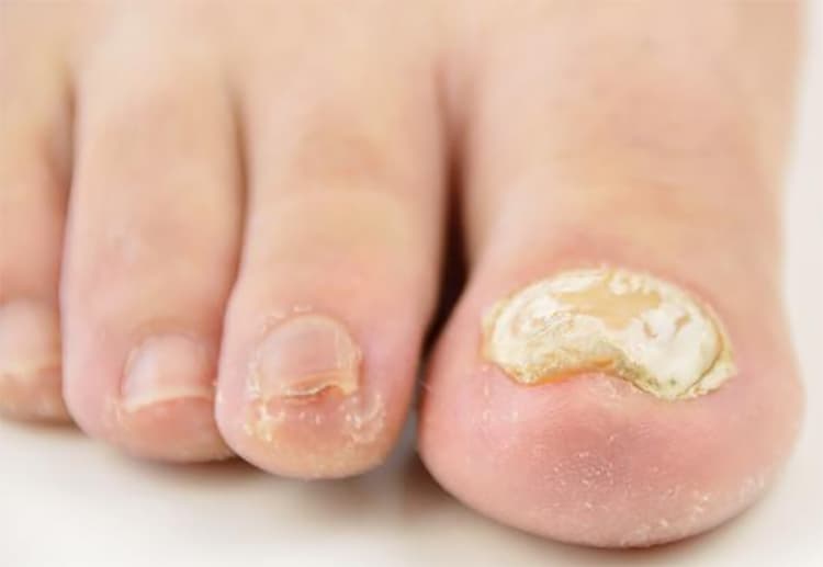 How to treat toenails fungus