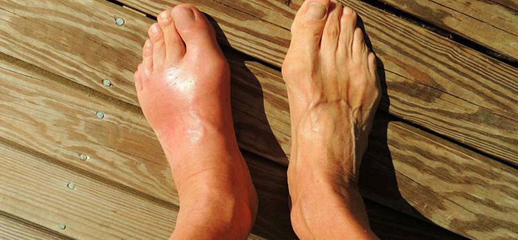 Complications Of Gout And How The Room Guides