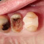How To Improve dental caries