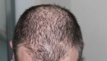 Ways-To-Stop-Hair-Loss-and-Regrow-Hair-Naturally-