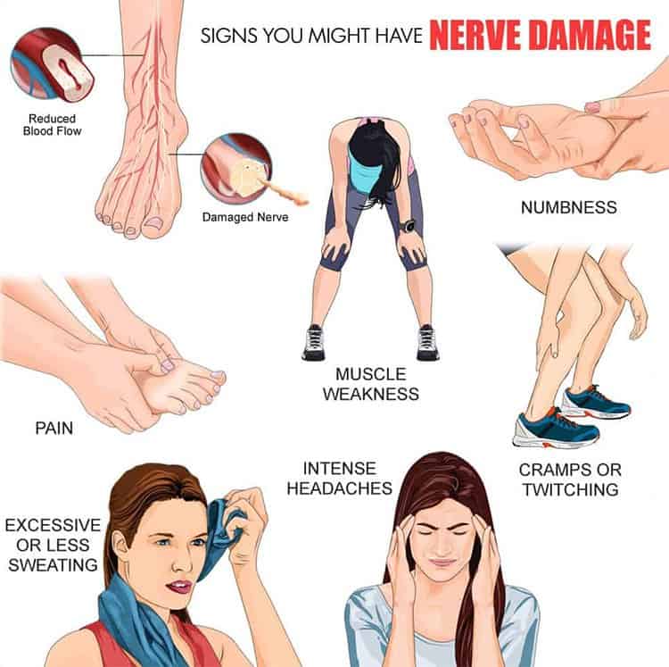 Nerve Damage