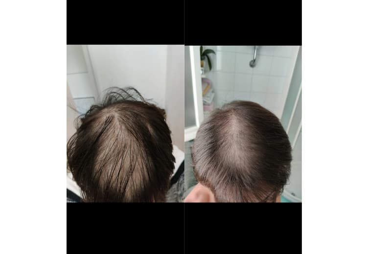 Trichofol Hair Regrowth Success