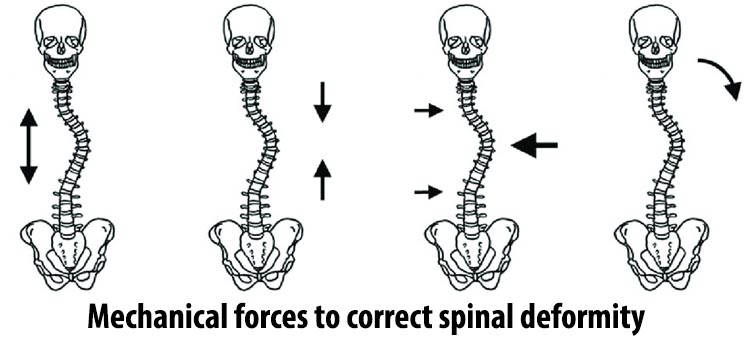 Mechanical forces to correct spinal deformity