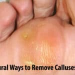 Best Natural Ways to Remove Calluses at Home