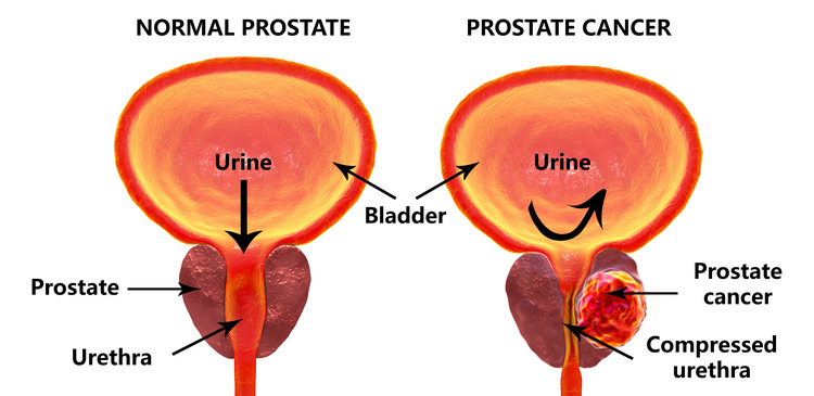 Causes and Symptoms of a Prostate Enlargement