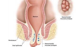 An Overview of Prolapsed Hemorrhoids