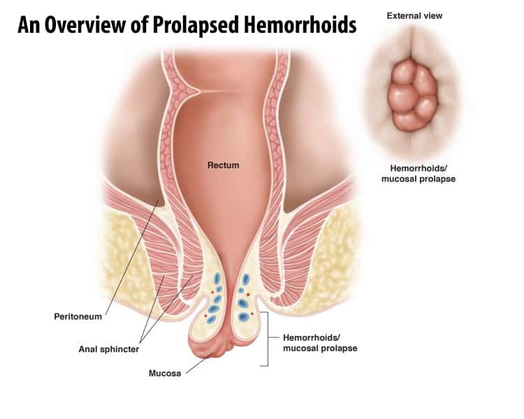 An Overview of Prolapsed Hemorrhoids