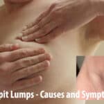 Armpit Lumps - Causes and Symptoms