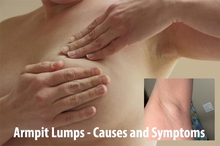 Armpit Lumps - Causes and Symptoms