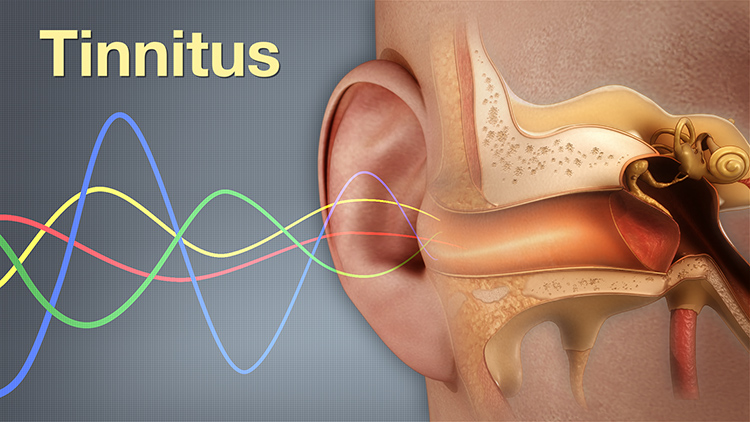 Tinnitus issues