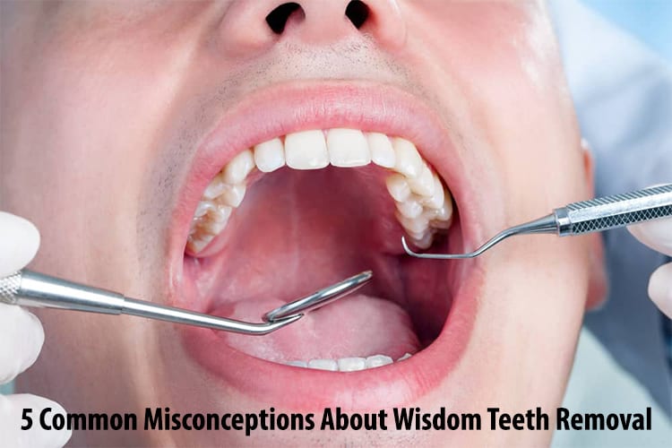 5 Common Misconceptions About Wisdom Teeth Removal