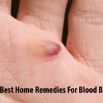 The 7 Best Home Remedies For Blood Blisters