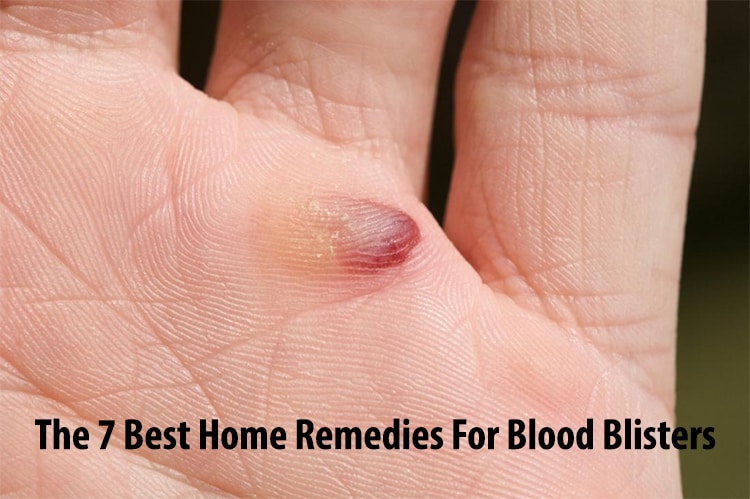 The 7 Best Home Remedies For Blood Blisters