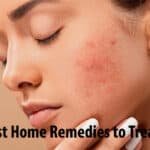 The 7 Best Home Remedies to Treat Acne