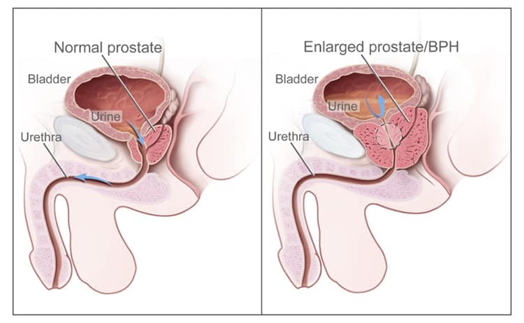 Inflammation in the prostate