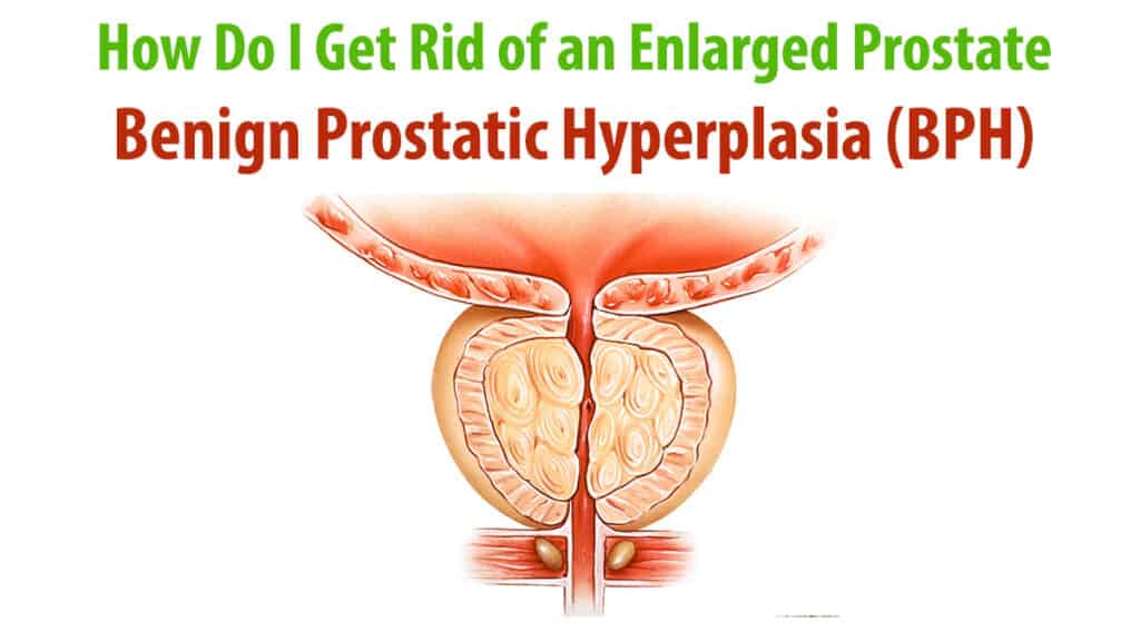How Do I Get Rid of an Enlarged Prostate - Benign Prostatic Hyperplasia (BPH)?
