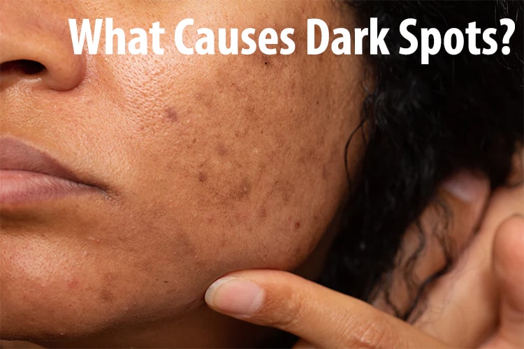 What Causes Dark Spots?