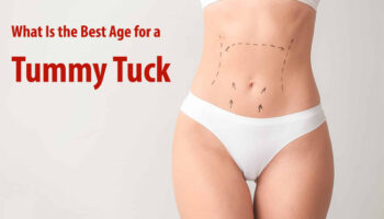 What Is the Best Age for a Tummy Tuck?