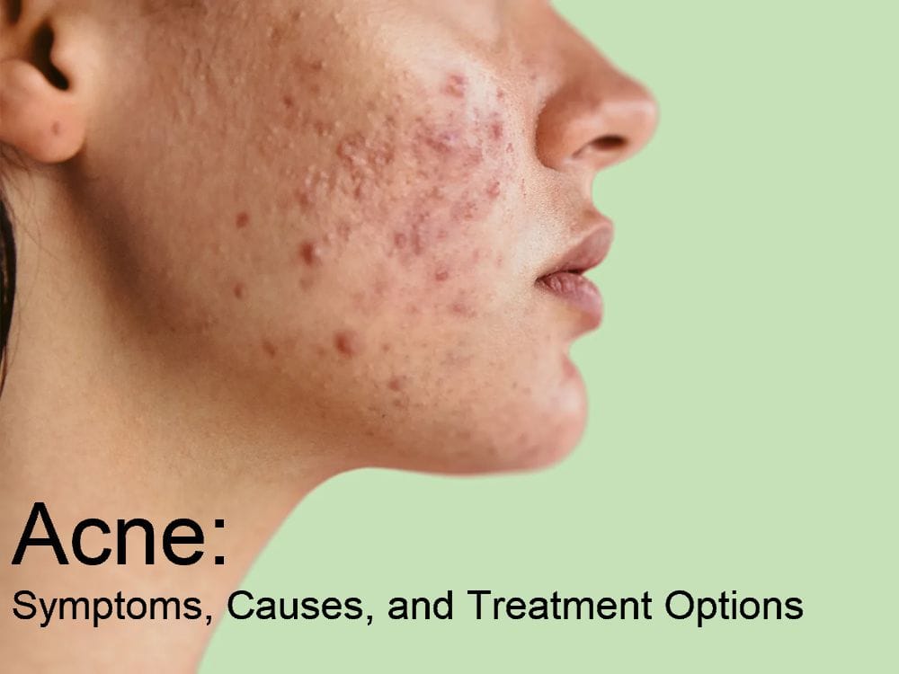 Acne: Symptoms, Causes, and Treatment Options
