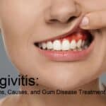 Gingivitis: Symptoms, Causes, and Gum Disease Treatment