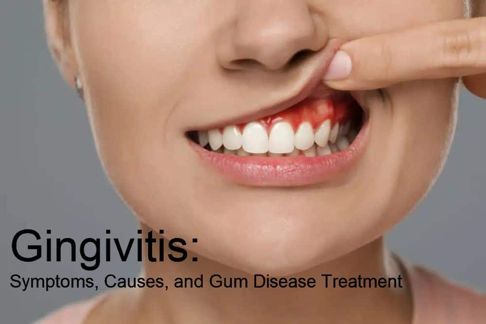 Gingivitis: Symptoms, Causes, and Gum Disease Treatment