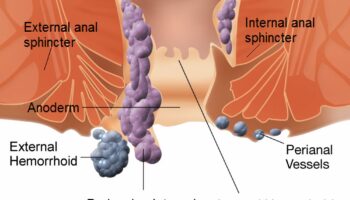 Hemorrhoid Symptoms and Causes: Treatment Options