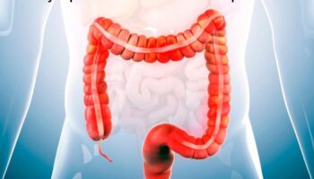 Irritable Bowel Syndrome: IBS Symptoms and Causes Explained